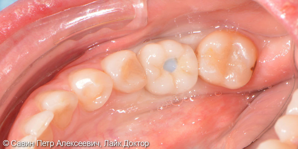 Установить имплантат в область утраченного зуба 3.6 - фото №6