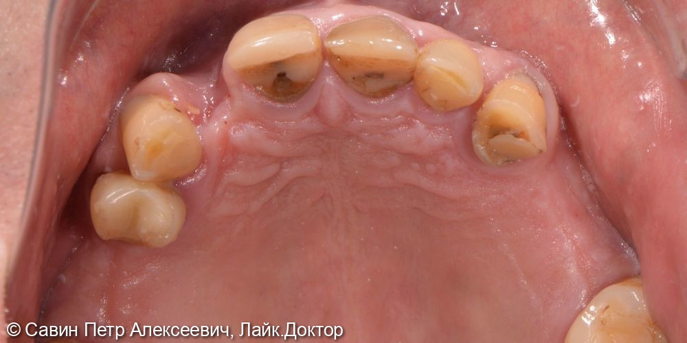 Протезирование с опорой на свои зубы - фото №3