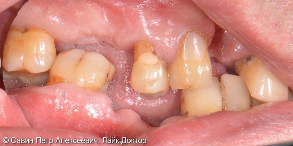 Протезирование с опорой на свои зубы - фото №4