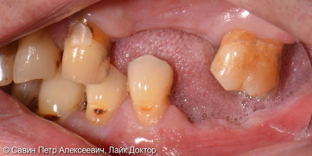 Протезирование с опорой на свои зубы - фото №5