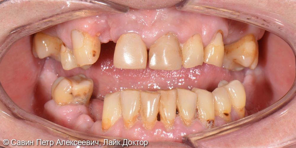 Протезирование с опорой на свои зубы - фото №6
