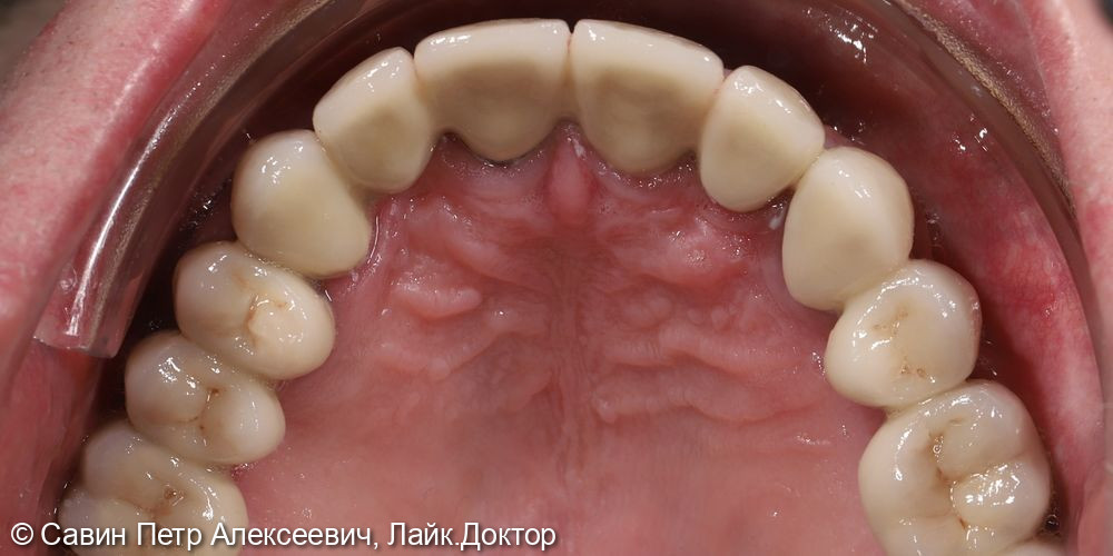 Протезирование с опорой на свои зубы - фото №7