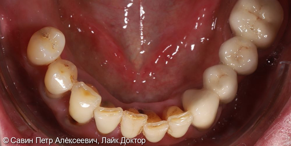 Протезирование с опорой на свои зубы - фото №8