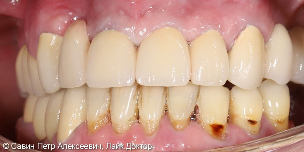 Протезирование с опорой на свои зубы - фото №10