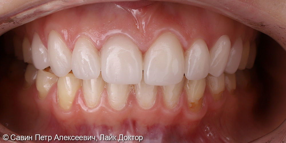 Восстановлении зубов керамическими винирами по технологии CAD/CAM CEREC - фото №2