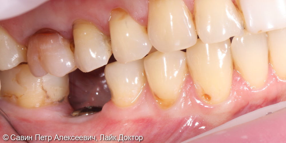 Протезирование цельноциркониевой коронкой зуба 46 - фото №1