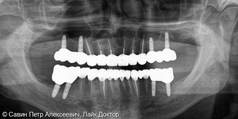 Тотальное протезирование - фото №5