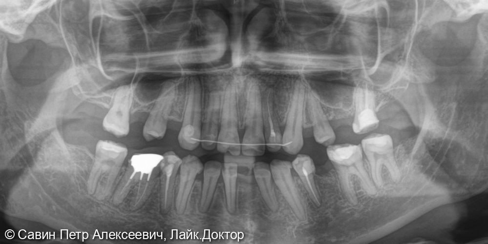 Имплантация 14,16,24,26,35,31 - фото №3