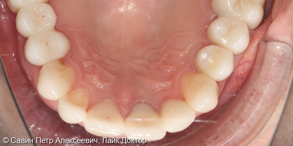 Тотальное протезирование верхней челюсти - фото №4