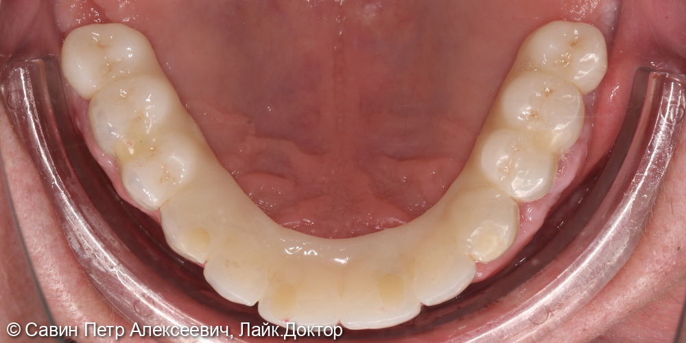 Тотальное протезирование верхней челюсти - фото №3