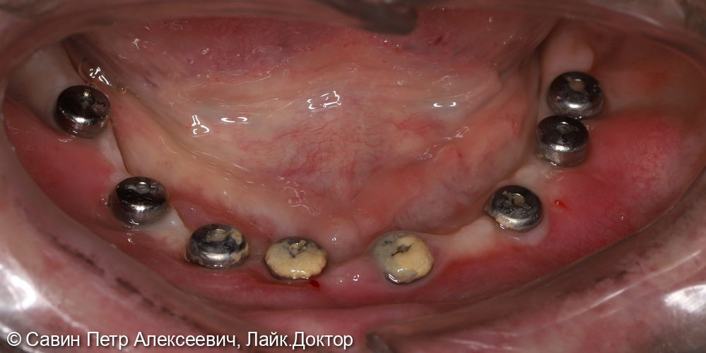 Имплантация нижней челюсти - фото №2