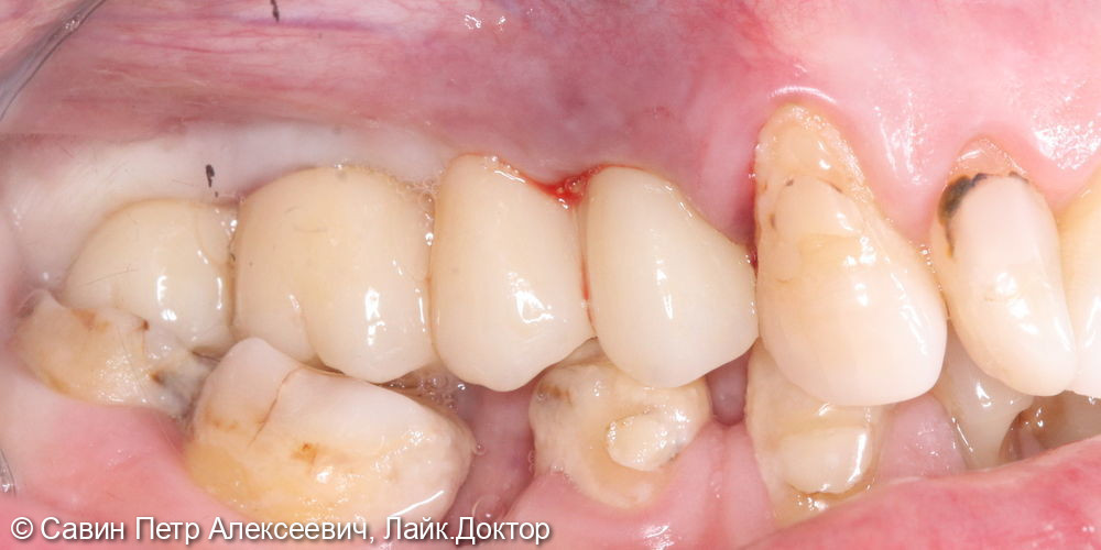 Протезирование боковых зубов - фото №2