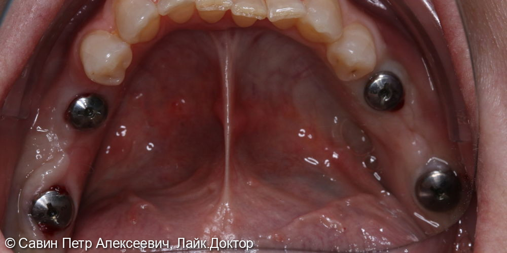 Протезирование боковых зубов с помощью имплантов - фото №3