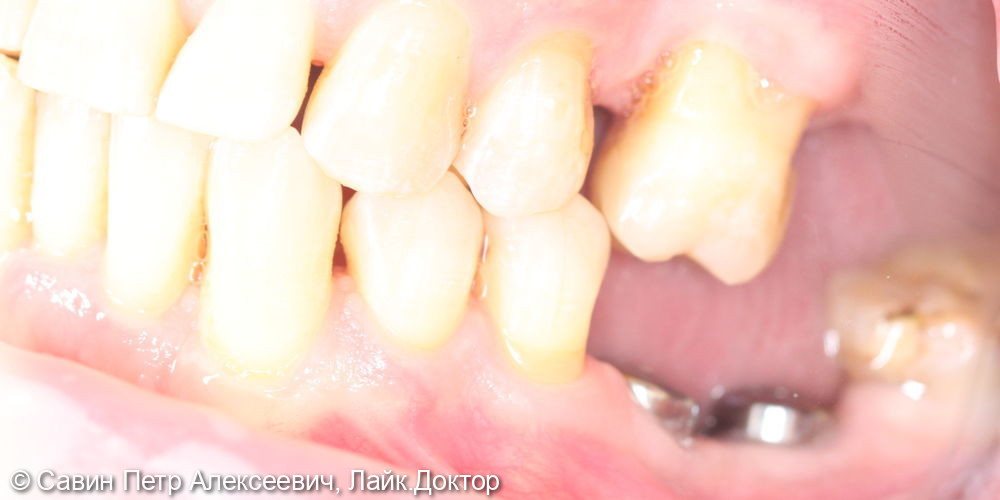 Протезирование боковых зубов на имплантах - фото №1
