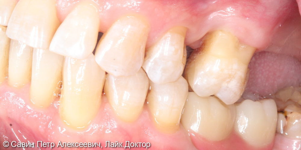 Протезирование боковых зубов на имплантах - фото №2