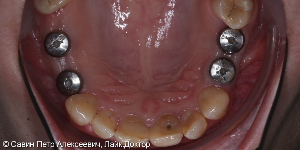 Протезирование боковых зубов - фото №1