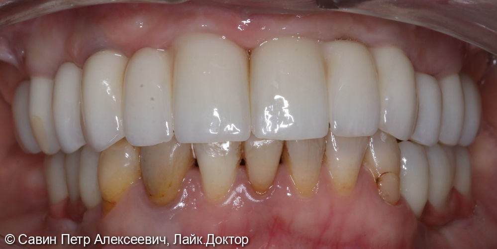 Коронки на зубах нижней челюсти - фото №1