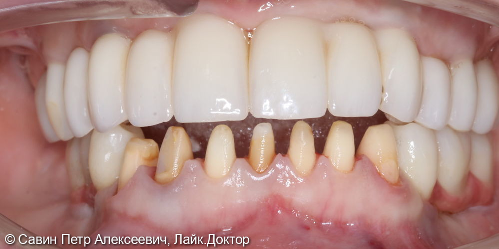 Коронки на зубах нижней челюсти - фото №2