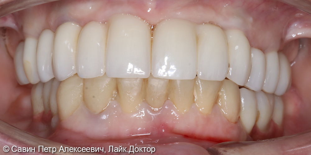 Коронки на зубах нижней челюсти - фото №3