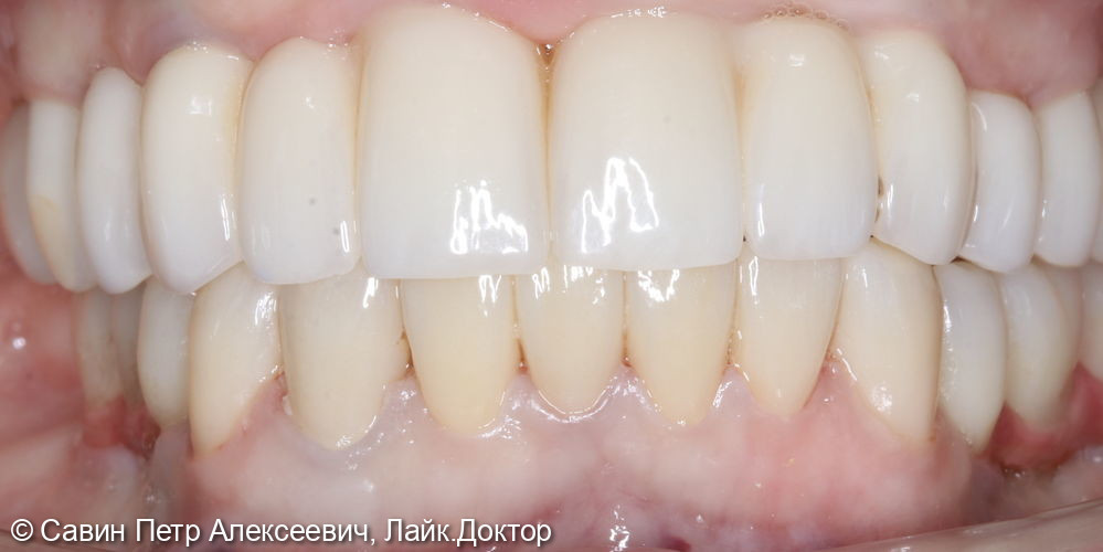 Коронки на зубах нижней челюсти - фото №4