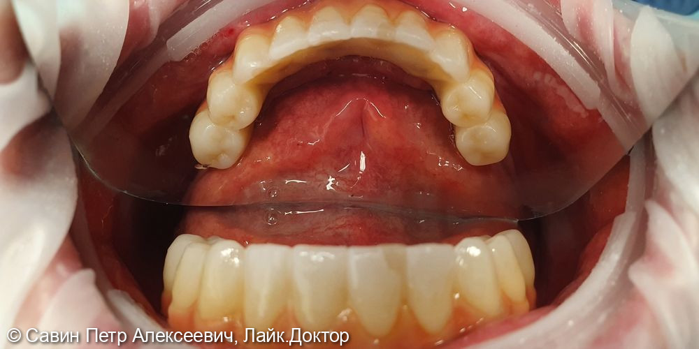 Тотальное протезирование - фото №2