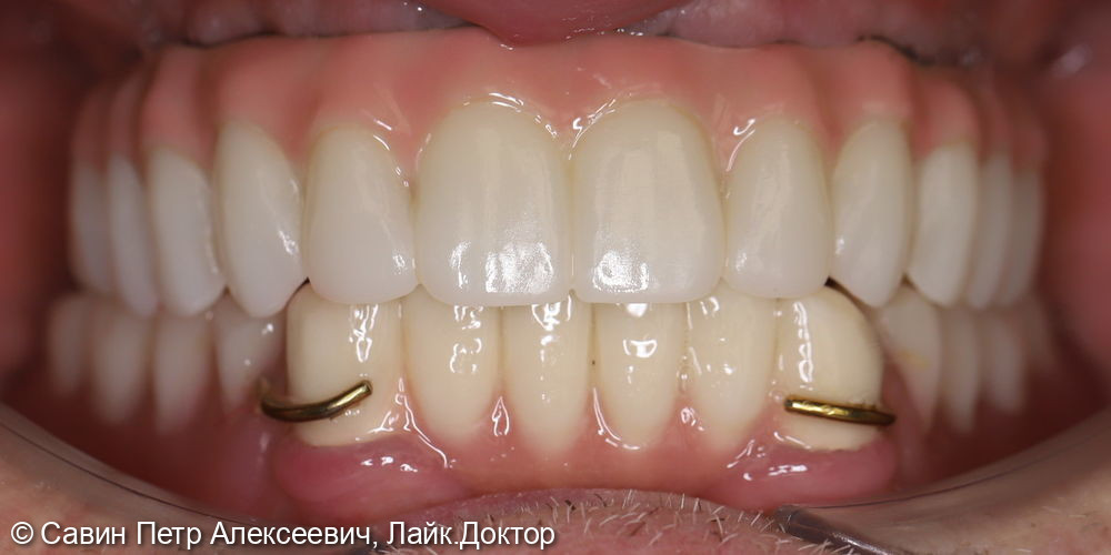 All-on 4 фото 2 · Вологда