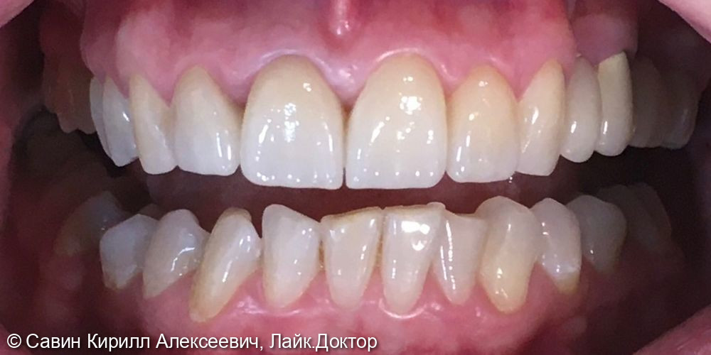 Протезирование зубов - фото №2