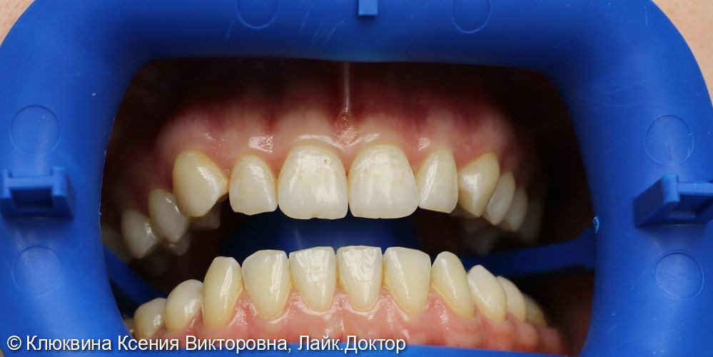 Отбеливание зубов ZOOM Томск Больничная доктор в тренде