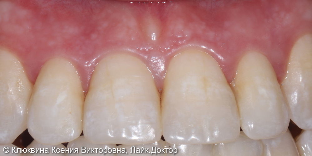 реставрация фронтальной группы зубов - фото №2