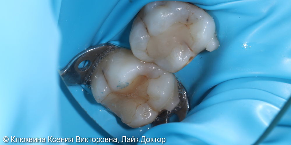 лечение кариеса во время ортодонтического лечения - фото №1