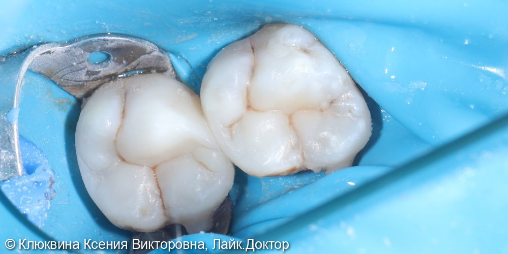 лечение кариеса во время ортодонтического лечения - фото №4