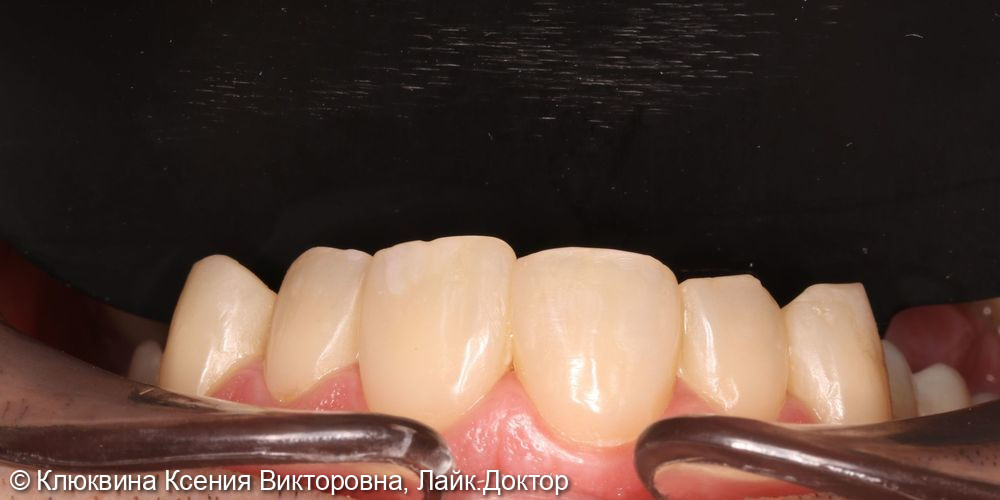 лечение фронтальной группы зубов - фото №6