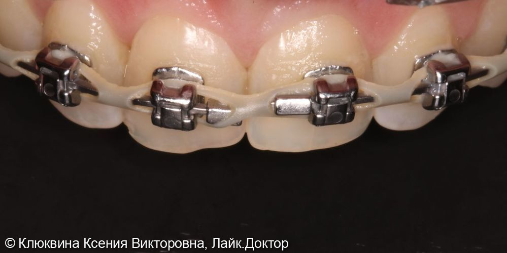 Реставрация фронтальной группы зубов - фото №1