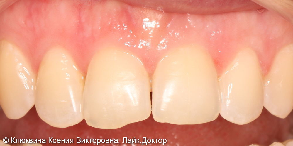 Реставрация фронтальной группы зубов - фото №2