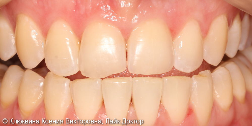 Реставрация фронтальной группы зубов - фото №3