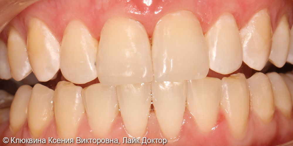 Реставрация фронтальной группы зубов - фото №4