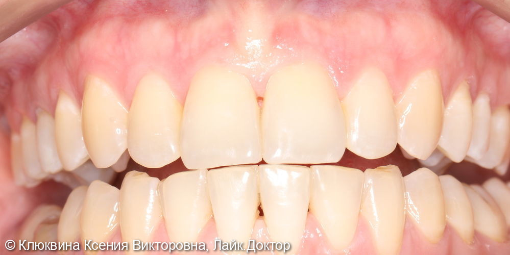 Реставрация фронтальной группы зубов - фото №5