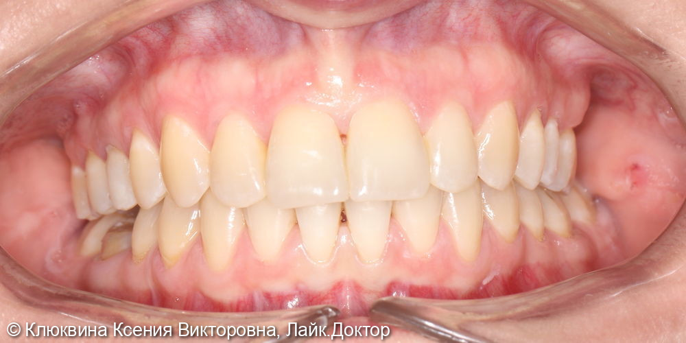 Реставрация фронтальной группы зубов - фото №6