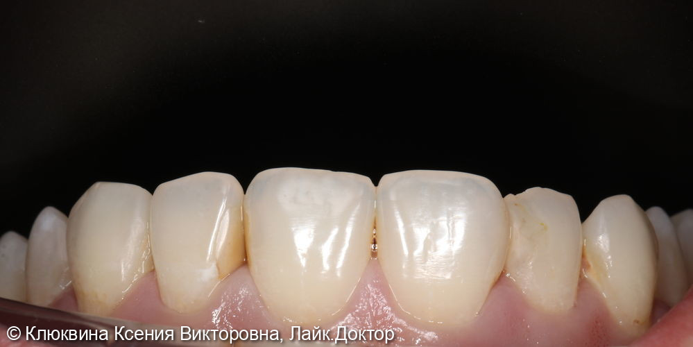 лечение фронтальной группы зубов - фото №1