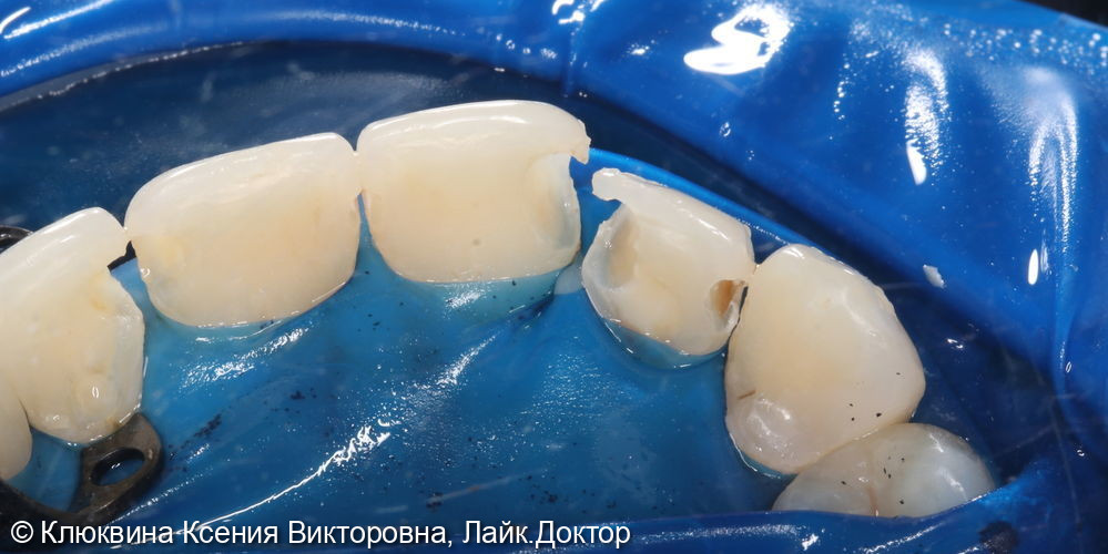 лечение фронтальной группы зубов - фото №2