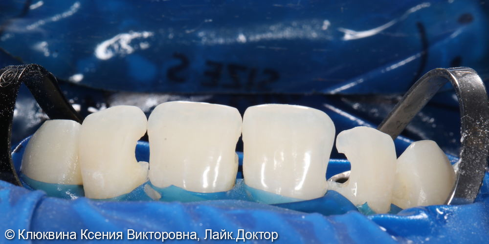 лечение фронтальной группы зубов - фото №3