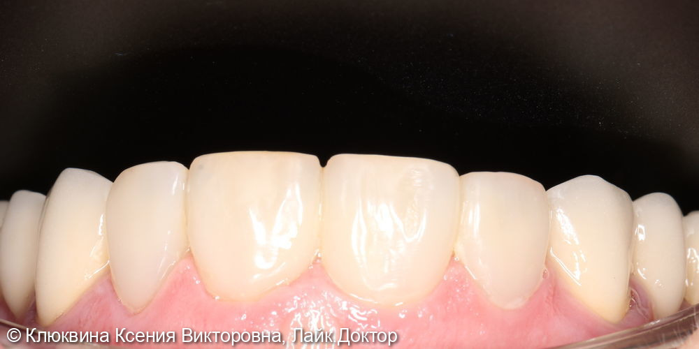 реставрация фронтальной группы зубов - фото №3
