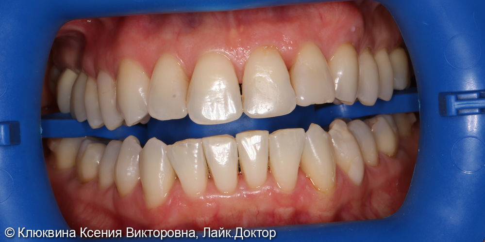 лечения фронтальной группы зубов - фото №1