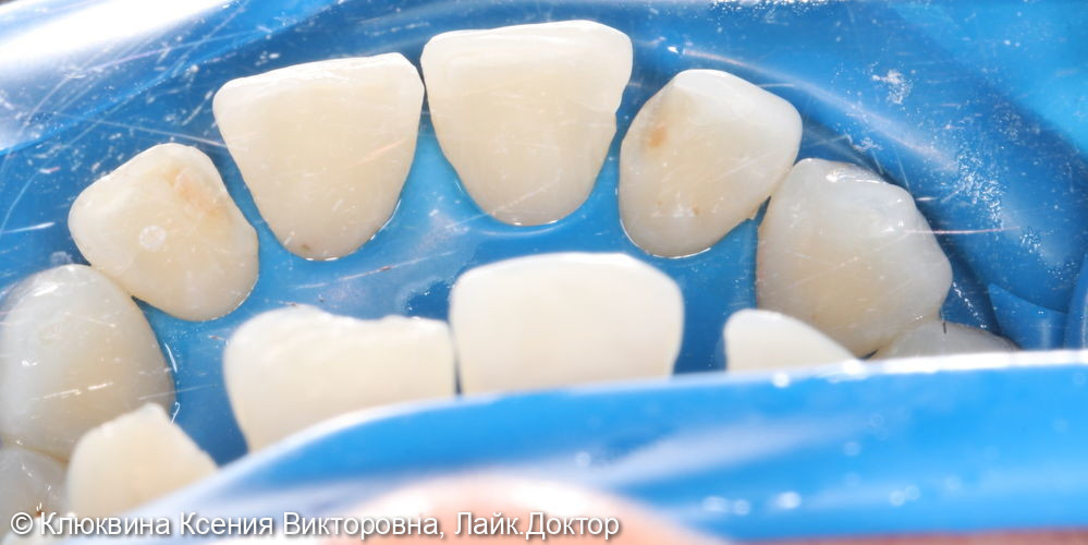 лечения фронтальной группы зубов - фото №3