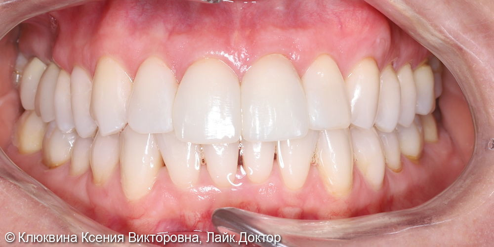 лечения фронтальной группы зубов - фото №4