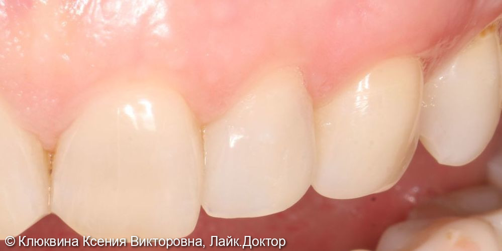 лечение фронтальной группы зубов - фото №4