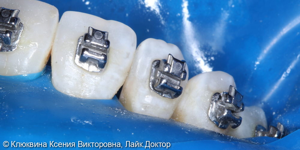 лечение фронтальной группы зубов - фото №5