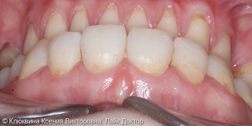 лечение фронтальной группы зубов - фото №1