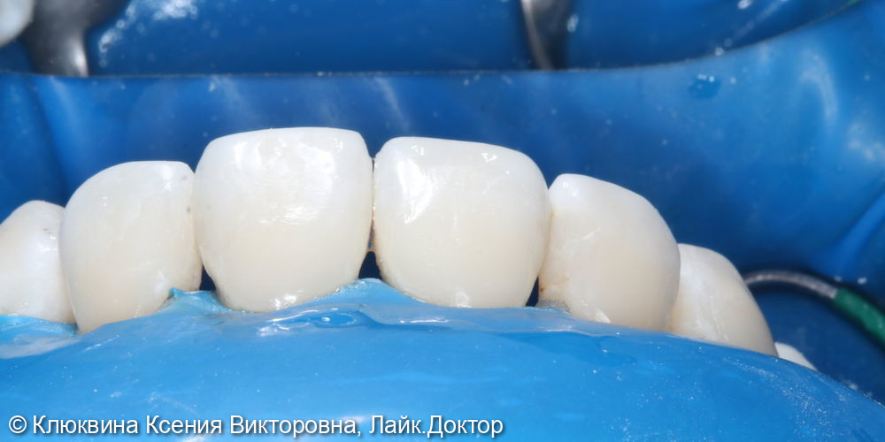 лечение фронтальной группы зубов - фото №4