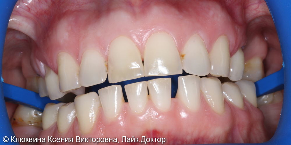 отбеливание зубов системой ZOOM 4 - фото №1